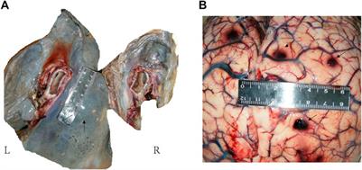 Case Report: Primary Pulmonary Angiosarcoma With Brain Metastasis